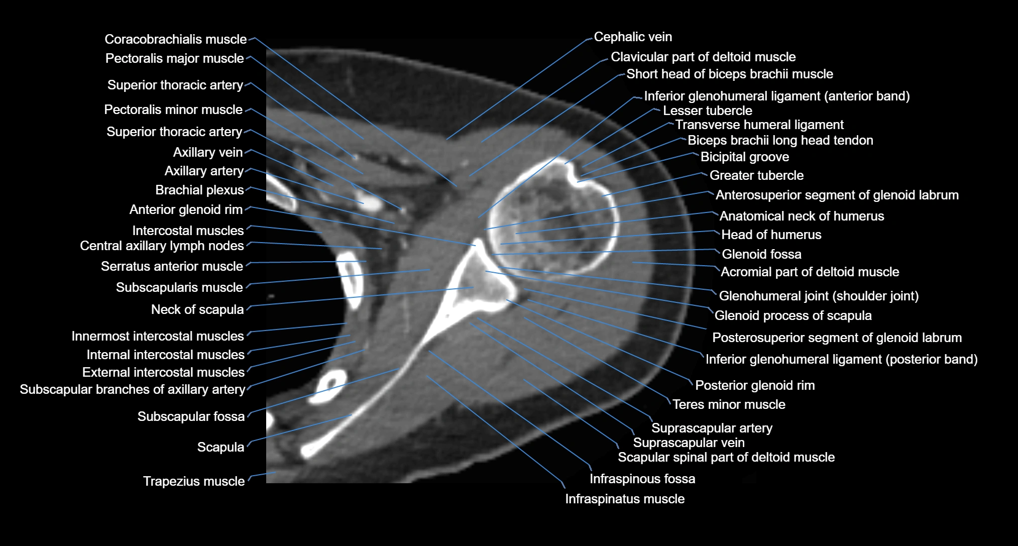 CT Shoulder axial cross sectional anatomy labelled radiology image -00034.webp